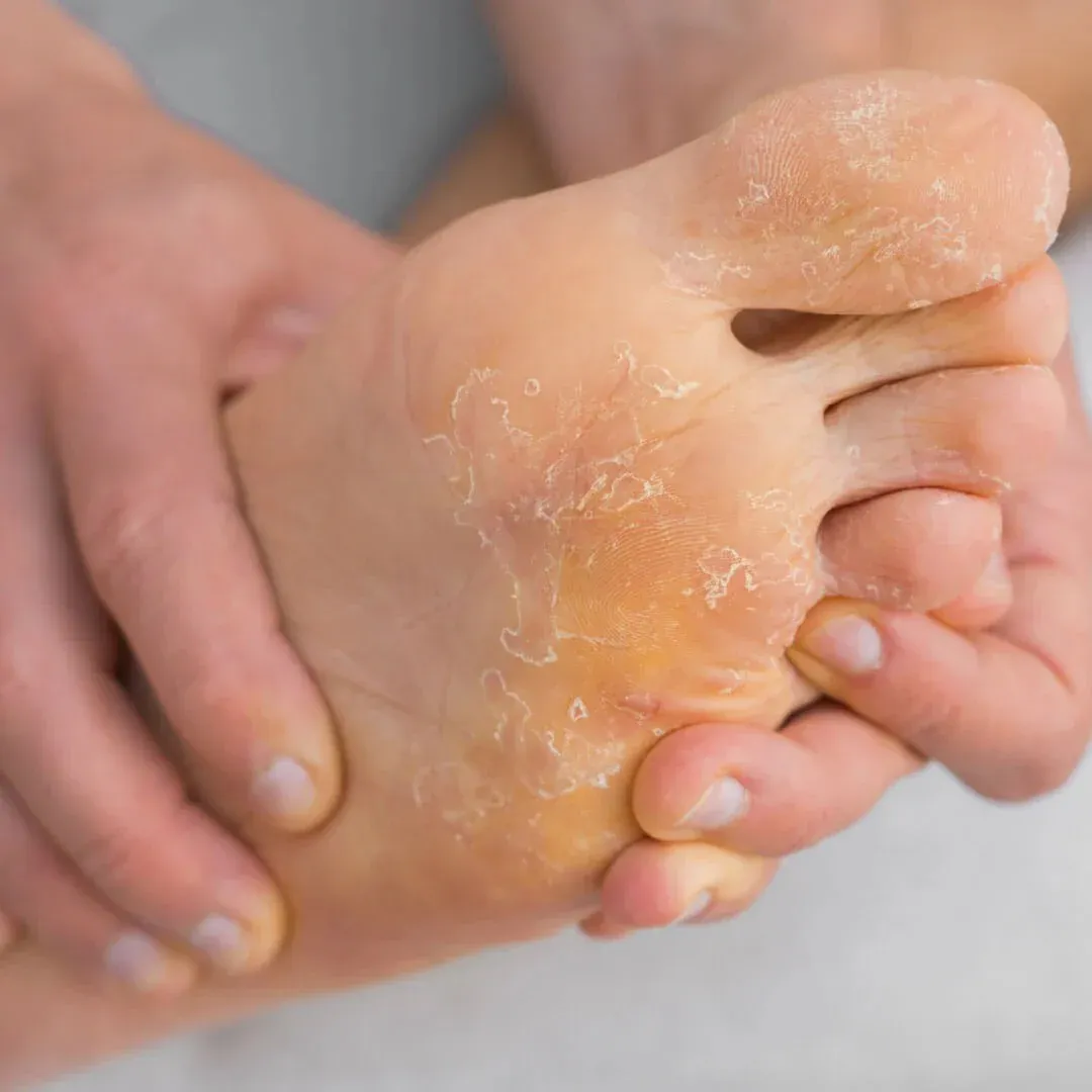 imgi_3_imgi_212_Peeling_skin_on_feet_2_1600x_55c4df6e-c228-47de-a0fd-c45fc846f851